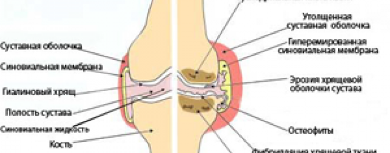 Артрит коленного сустава